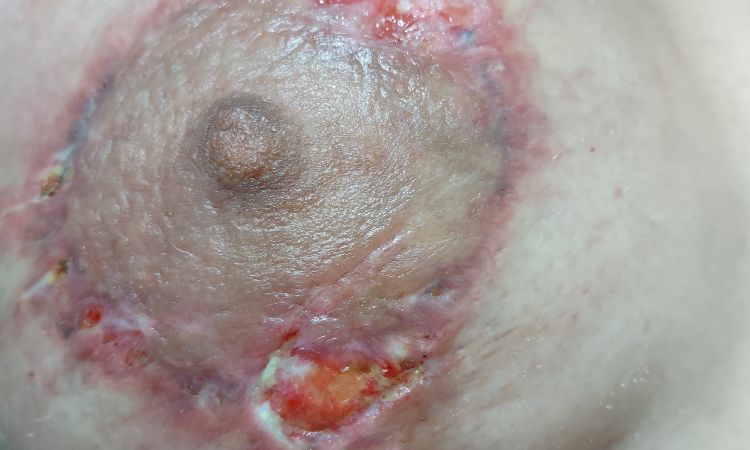Ayudar a cerrar una herida post matopexia - 55473