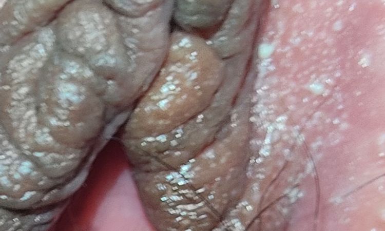 Bolitas y labio partido tras 3 meses labioplastia - 55554