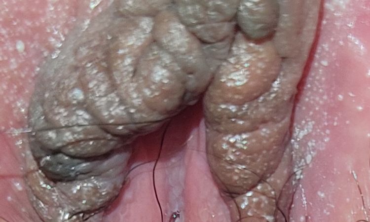 Bolitas y labio partido tras 3 meses labioplastia - 55555