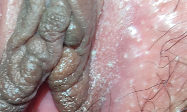 Bolitas y labio partido tras 3 meses labioplastia - 55556