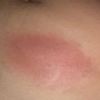 Bulto en el abdomen después de 9 días de Hidrolipoclasia