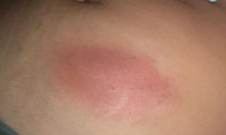Bulto en el abdomen después de 9 días de Hidrolipoclasia - 55577