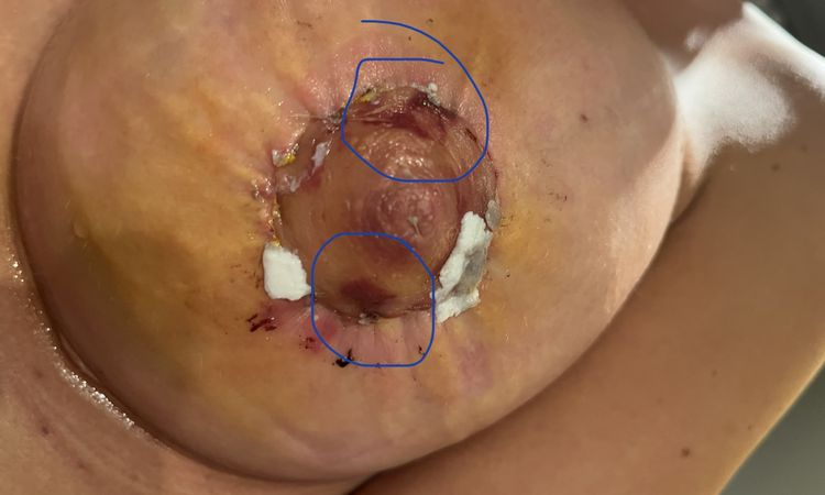 Hematoma areola tras aumento de pecho - 56221