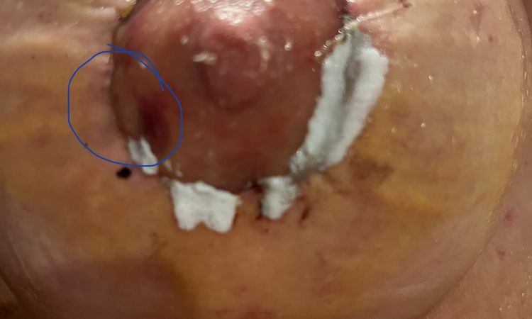 Hematoma areola tras aumento de pecho - 56222