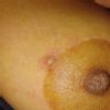 Grano de pus al lado del pezón tras mastopexia