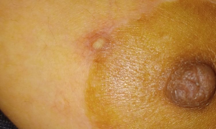 Grano de pus al lado del pezón tras mastopexia - 56271