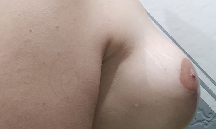 Prótesis muy separadas tras mastopexia - 56287