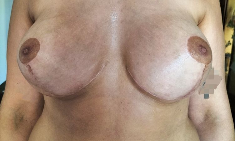Prótesis muy separadas tras mastopexia - 56292