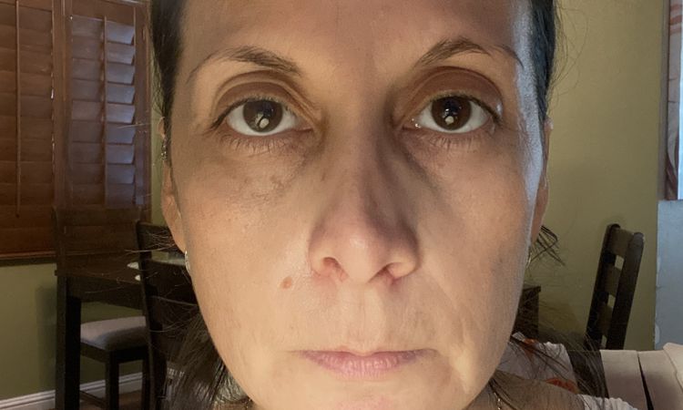 Nariz deforme y asimétrica después de mi rinoplastia - 56408