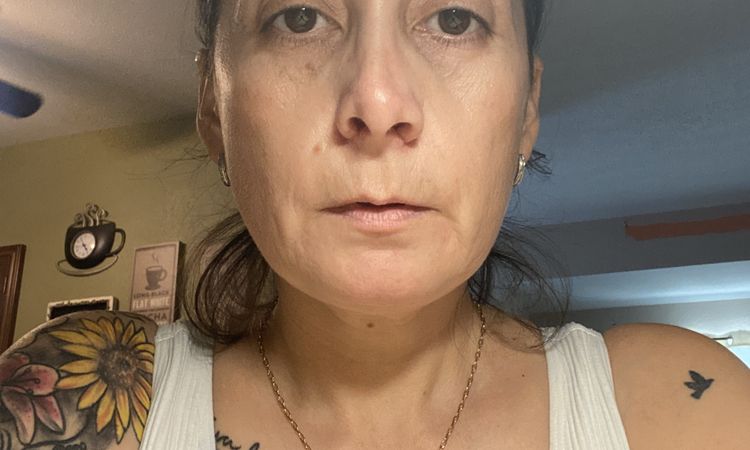 Nariz deforme y asimétrica después de mi rinoplastia - 56409