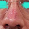 Cicatriz hundida en nariz por necrosis tras rinoplastia secundaria - 56429