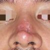 Cicatriz hundida en nariz por necrosis tras rinoplastia secundaria - 56430