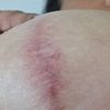 Son normales estos vasitos en la cicatriz de mi mastopexia?