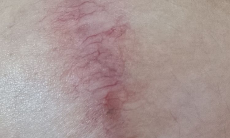 Son normales estos vasitos en la cicatriz de mi mastopexia? - 56467