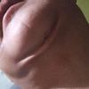 Pliegue de piel tras lipopapada hace 7 días - 56609