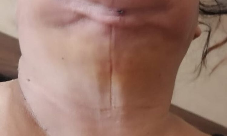 Pliegue de piel tras lipopapada hace 7 días - 56610