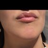Asimetría y hendiduras y bultos tras aumento de labios