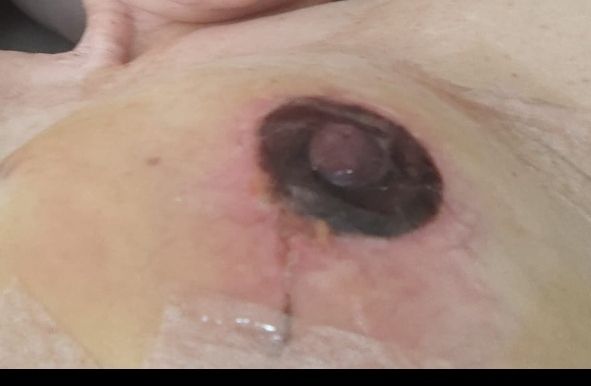 Areola y pezón negros tras reducción mamaría - 56793