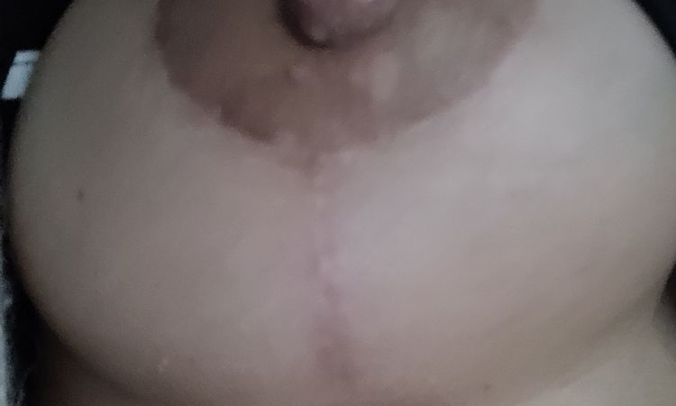 Dolor bajo el pezón después de 5 meses de mastopexia - 56883
