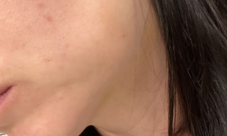 Fibrosis y bulto en mejilla tras colocación de hilos tensores - 56970