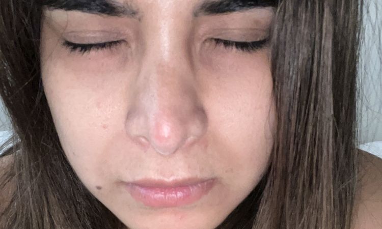 Marcas blancas post rinoplastia - 56997