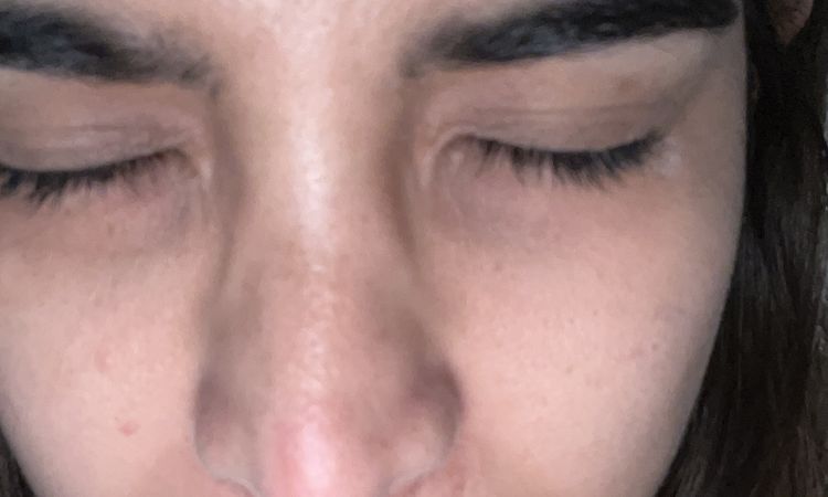 Marcas blancas post rinoplastia - 56998