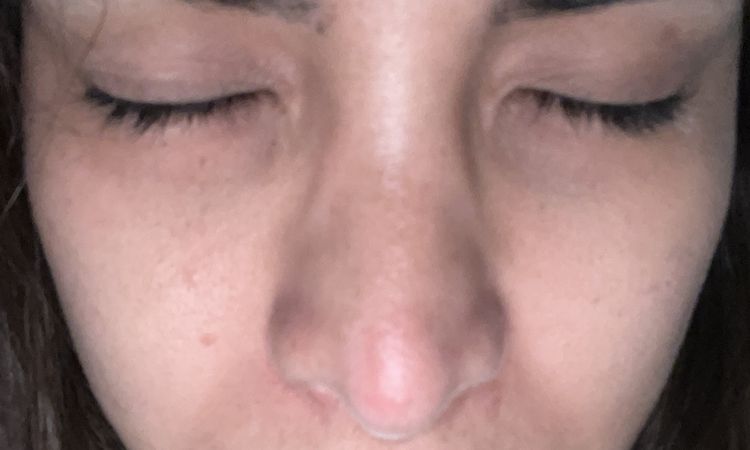 Marcas blancas post rinoplastia - 56999