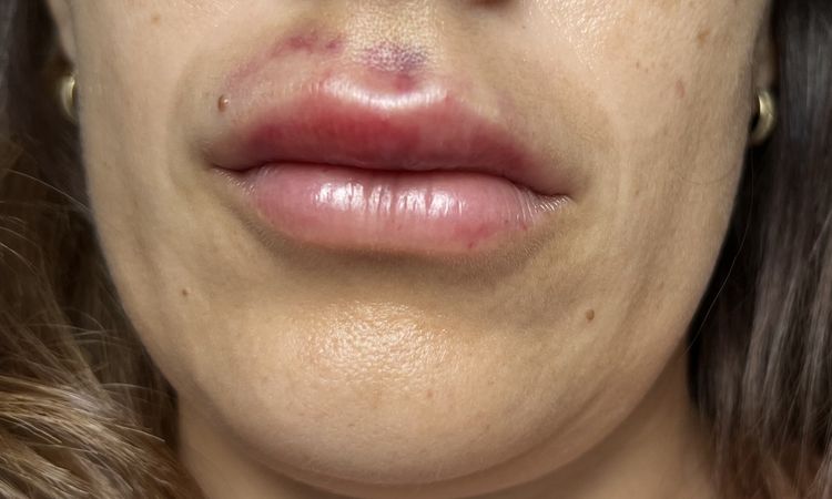 Hematoma o necrosis tras aumento de labios - 57011