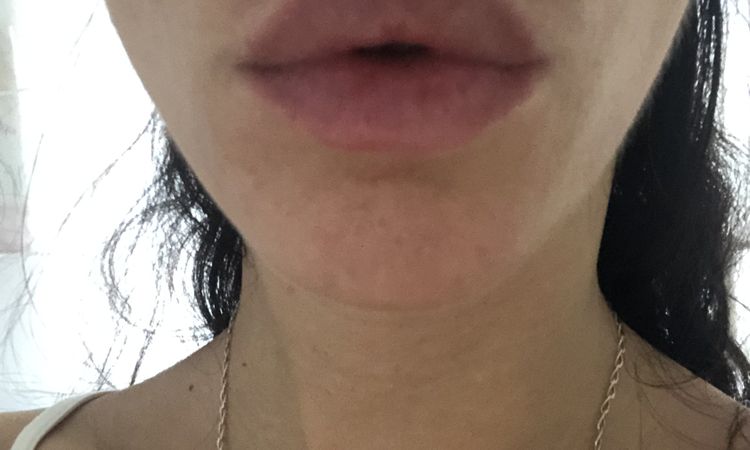 ¿Melasma o mancha por efecto Tyndall tras aumento de labios? - 57039