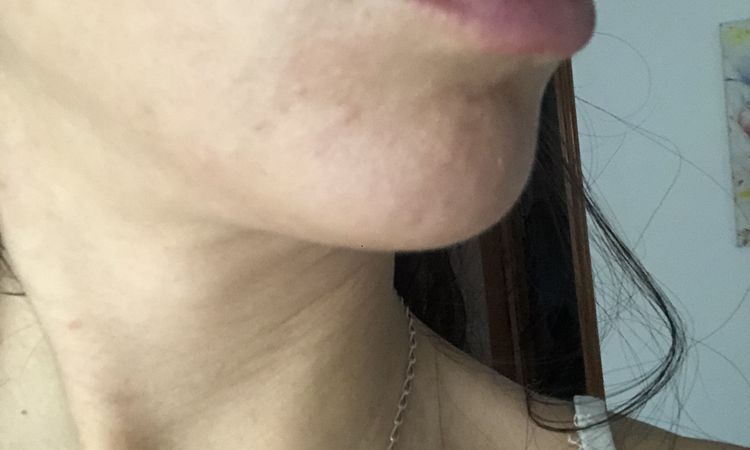 ¿Melasma o mancha por efecto Tyndall tras aumento de labios? - 57040