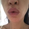 ¿Melasma o mancha por efecto Tyndall tras aumento de labios?