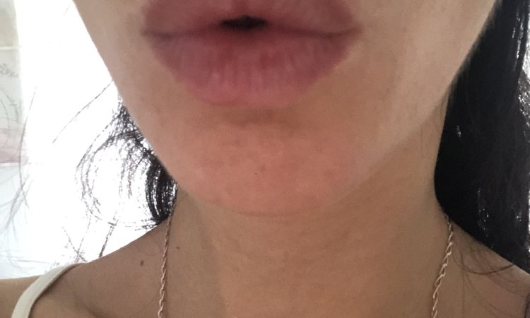 ¿Melasma o mancha por efecto Tyndall tras aumento de labios? - 57041