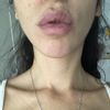 ¿Melasma o mancha por efecto Tyndall tras aumento de labios?