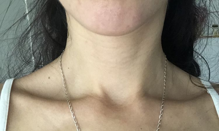 ¿Melasma o mancha por efecto Tyndall tras aumento de labios? - 57042