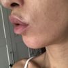 ¿Melasma o mancha por efecto Tyndall tras aumento de labios? - 57043