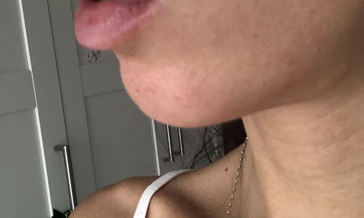 ¿Melasma o mancha por efecto Tyndall tras aumento de labios? - 57043