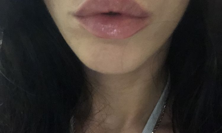 ¿Melasma o mancha por efecto Tyndall tras aumento de labios? - 57044