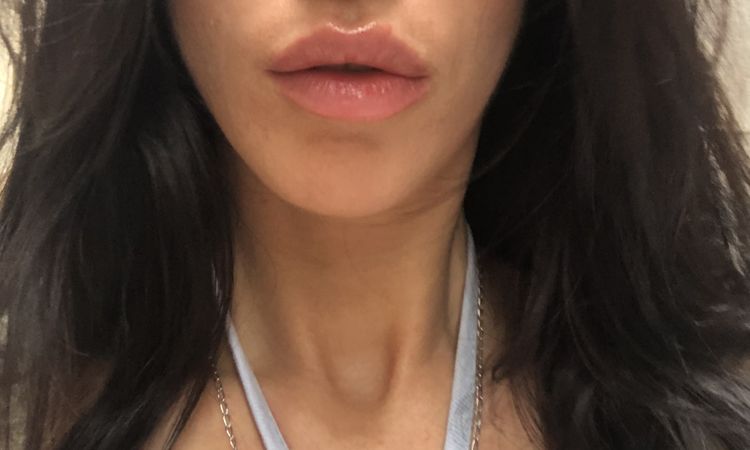 ¿Melasma o mancha por efecto Tyndall tras aumento de labios? - 57045