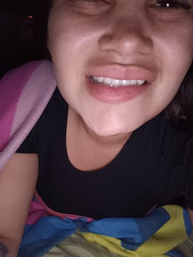 Parálisis facial tras 1 mes de lipopapada y marcación mandibular