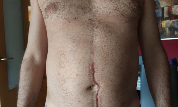 Mejor técnica para corregir una cicatriz abdominal vertical de 22 cm - 57294