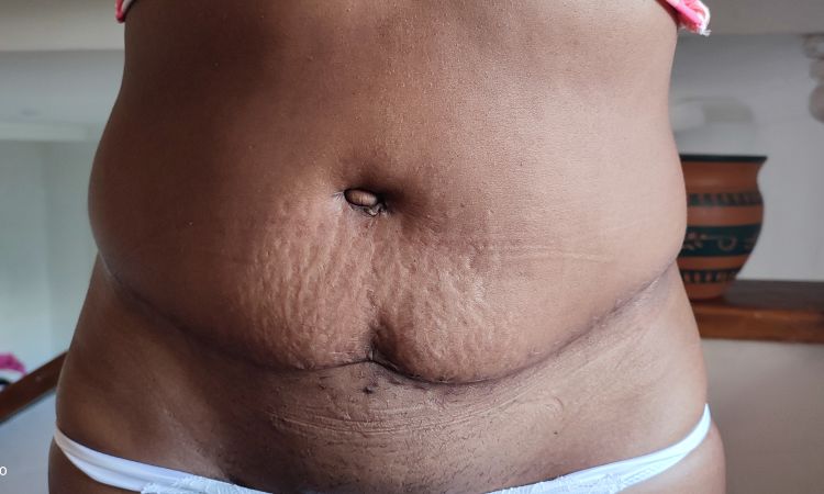 Abdomen con bolsas tras abdominoplastia - 57311
