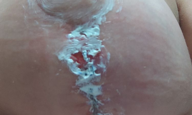 Heridas de mastopexia abiertas por seroma desde el 10 de agosto - 57312