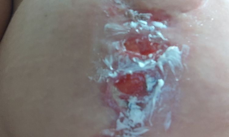 Heridas de mastopexia abiertas por seroma desde el 10 de agosto - 57313