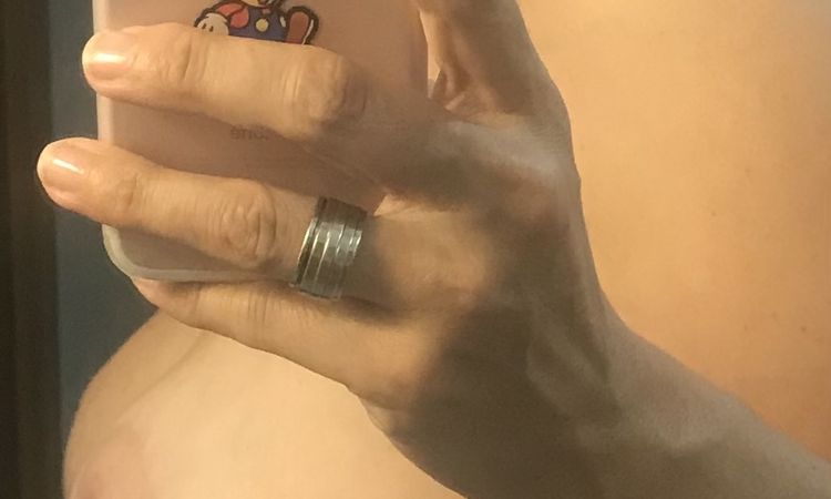Pecho caído tras 8 meses de mastopexia con implantes 335cc motiva full - 57358