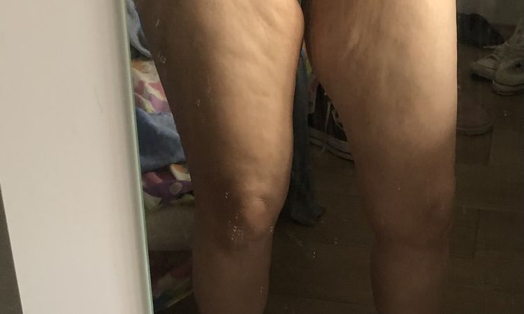 Dudas sobre cicatriz en Lifting de muslos - 57403