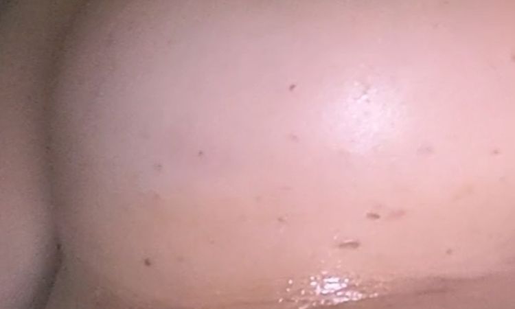 Mis surcos mamarios naturales no coinciden con los hechos en la mastopexia - 57521