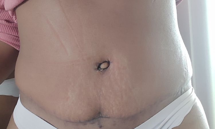 ¿Esto es un resultado normal de abdominoplastia? - 57533