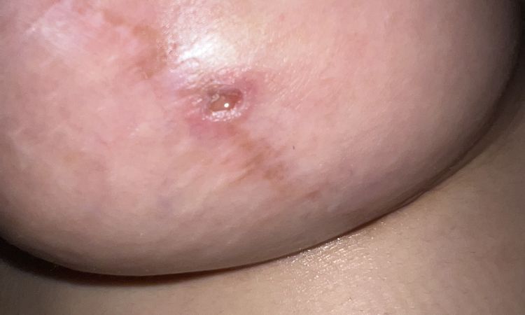 Punto se abre tras 4 meses de mastopexia - 57538