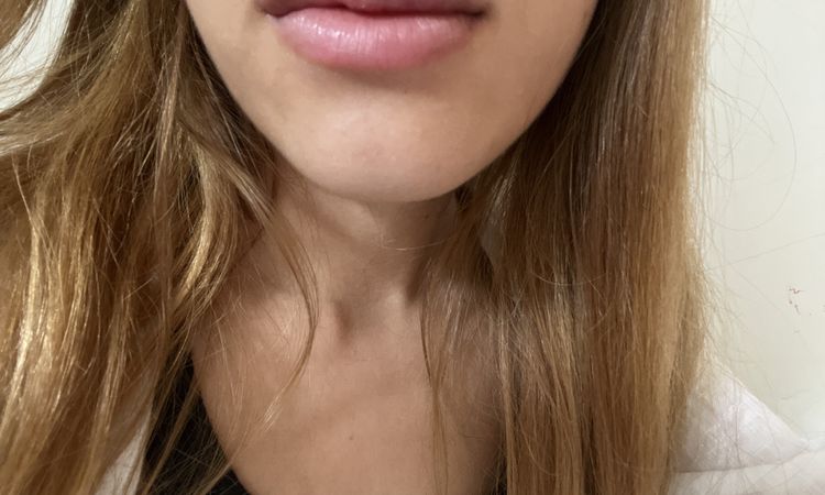 Labios duros después de inyectar Ácido hialurónico - 57557