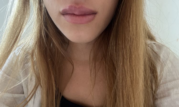 Labios duros después de inyectar Ácido hialurónico - 57559